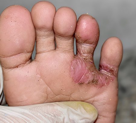 Prostep-Podiatry-Fungal-Infections
